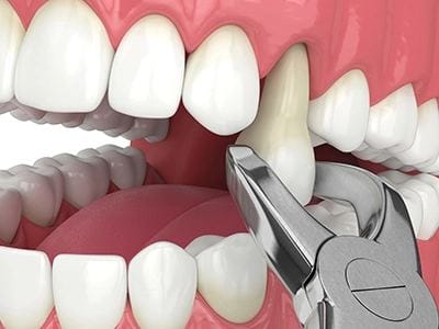 Tooth Extractions