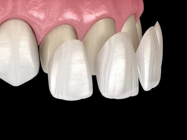 Veneers