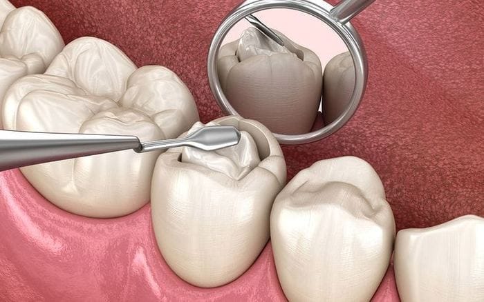 Restorations & Fillings